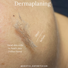 Load image into Gallery viewer, Dermaplaning