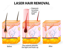 Load image into Gallery viewer, Laser Hair Removal