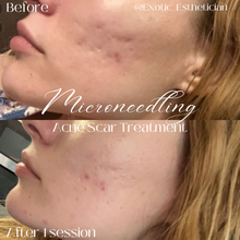 Load image into Gallery viewer, Skinpen Microneedling + PRP