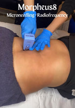 Load image into Gallery viewer, Morpheus Microneedling + Radiofrequency