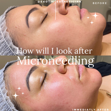 Load image into Gallery viewer, Skinpen Microneedling + PRP